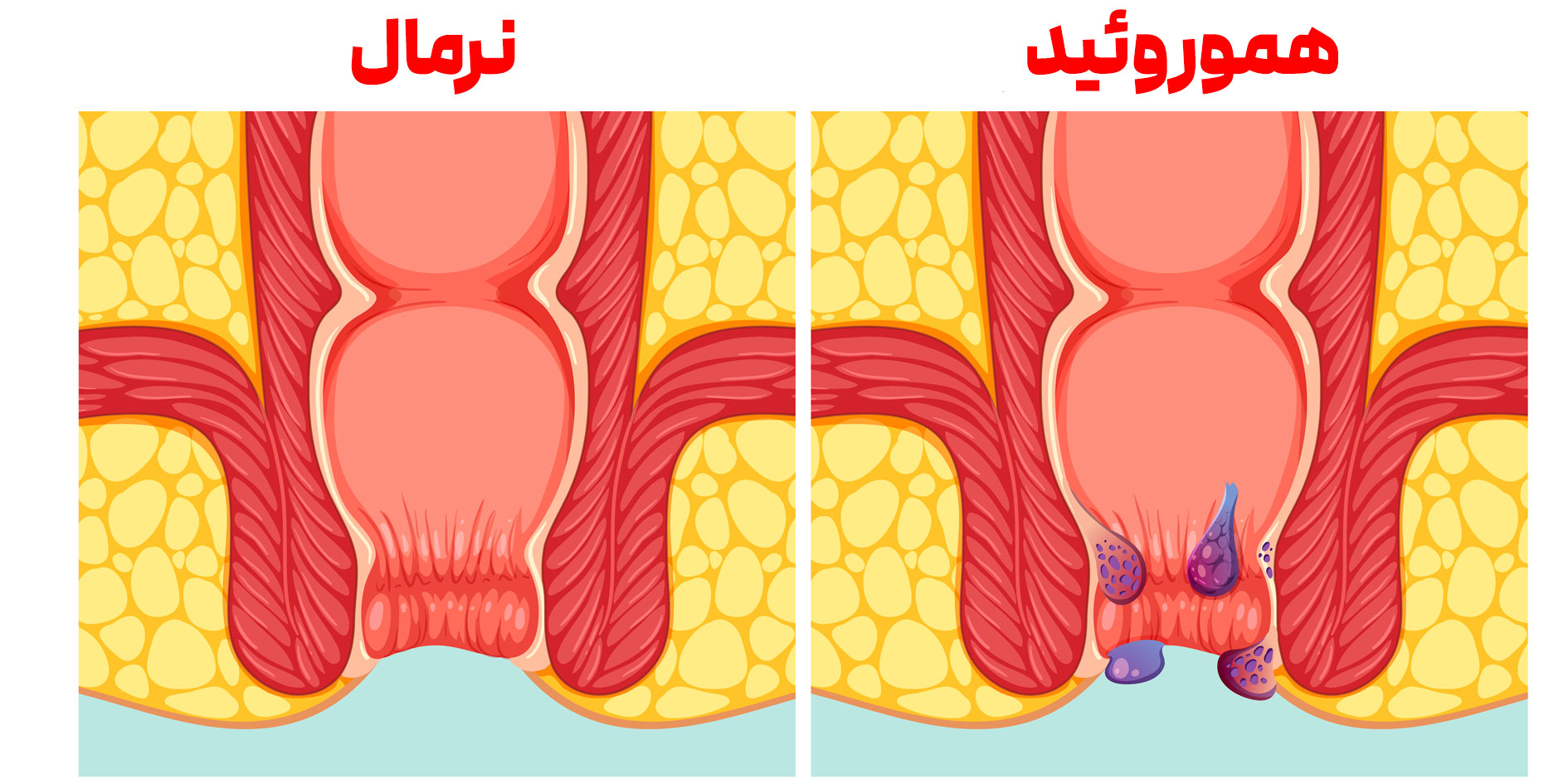  مقایسه هموروئید و حالت عادی