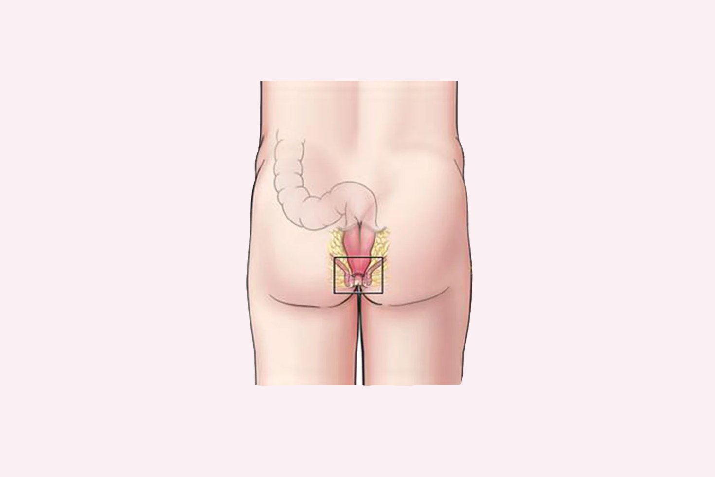 cross-section-of-the-rectum-and-anal-canal-illustration-of-hemorrhoids-structure-vectorسس