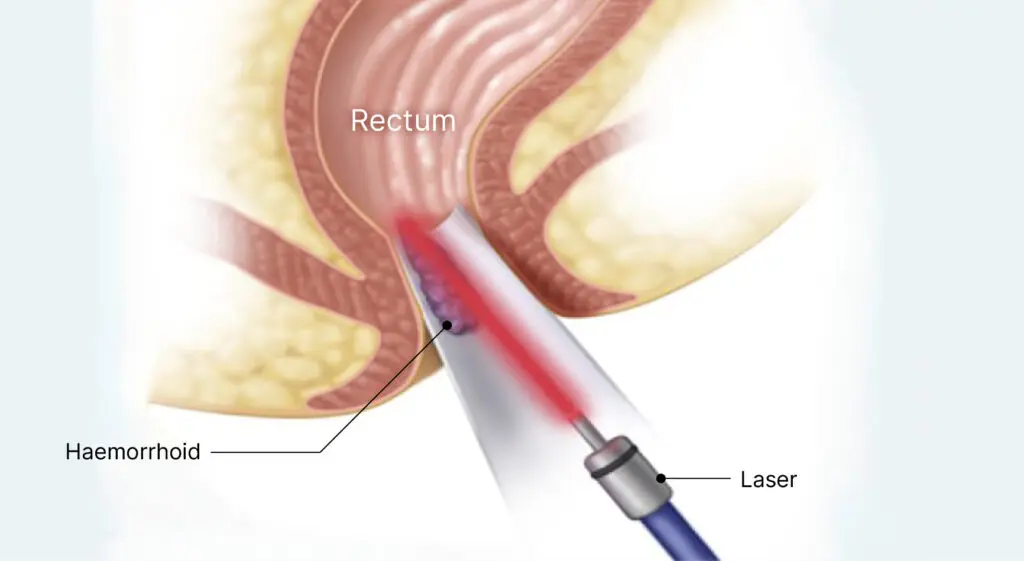 درمان همورئید با لیز بهترین راه درمان
