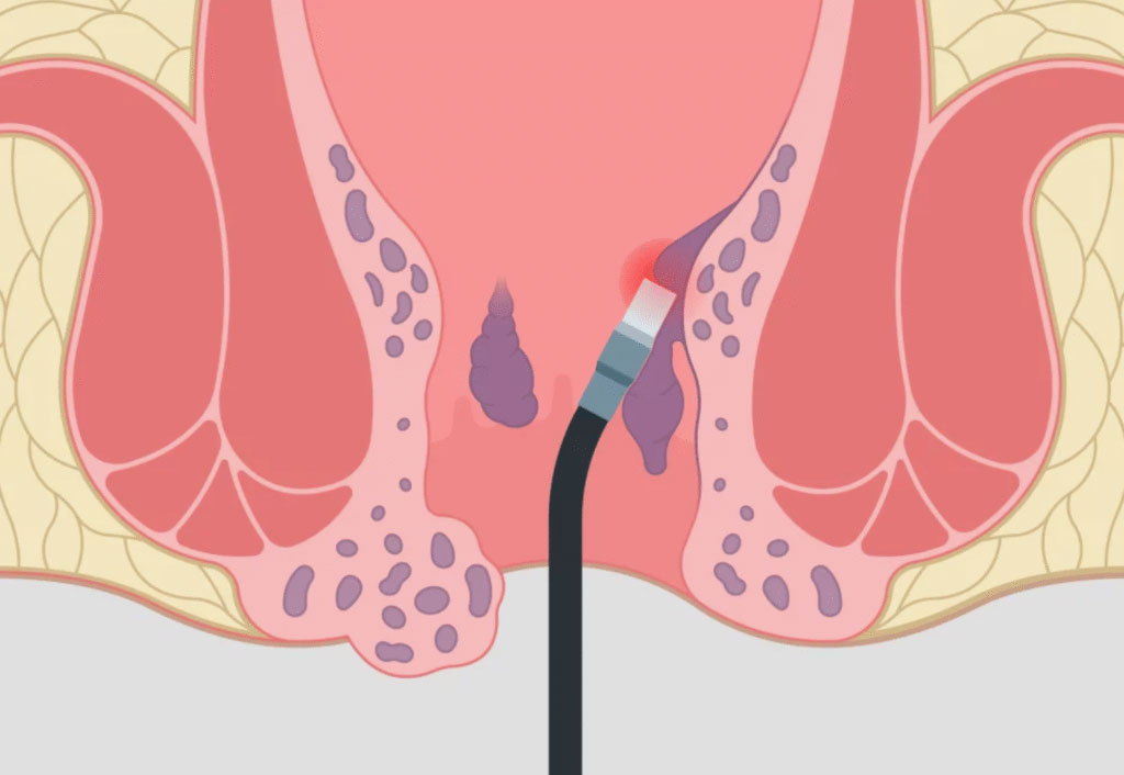 لیزر-همورئید-درمانی-مطئن-تر